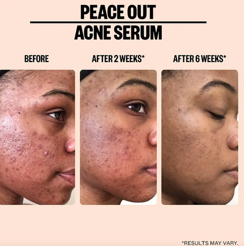 Sèrum facial anti-imperfectes Peace Out anti-acne